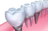 Dental-Implants-in-Sydney.jpg